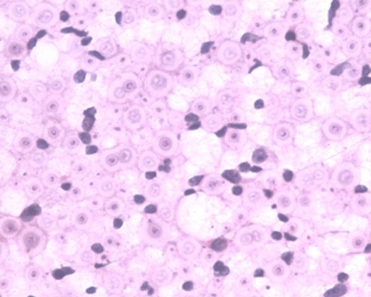 Case 1(d): Histopathological examination of the axillary lymph nodes shows evidence of cryptoccoccal infection (capsulated organisms) (magnified view).