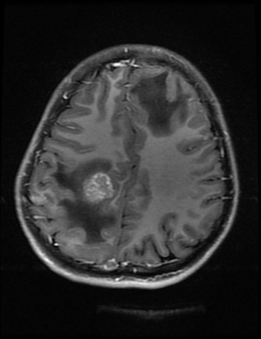 Case 2(a): Axial T1 weighted post-contrast image of brain shows ring-enhancing lesion with surrounding oedema in the right parietal lobe.