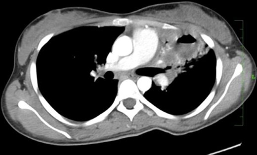 Case 2(b): Axial post-contrast CT image of the chest in mediastinal window shows cavitating consolidation in the left upper lobe with extension into the hilum.