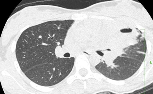 Case 2(c): Axial CT image of the chest in lung window shows cavitating consolidation in the left upper lobe.