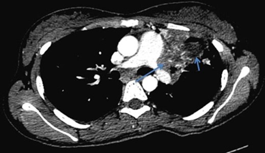 Case 2(d): Axial post-contrast CT image of the chest in mediastinal window shows cavitating consolidation (short arrow) in the left upper lobe with extension into the hilum and narrowing of the hilar structures (long arrow).