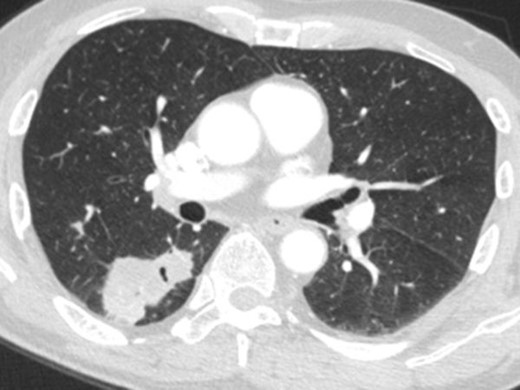 Case 3: Axial CT image of the thorax in lung window shows a mass with irregular margins in the right lower lobe.