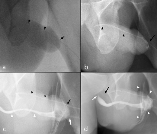 (a–d) A 23-year-old male with urethral duplication. Findings: RUG fluoroscopic coned-down spot images demonstrating (a) cannulation of the dorsal urethra meatus (black arrow) with minimal opacification of the dorsal urethra owing to resistance to Cystografin contrast flow (black arrow heads). (b) Continued gradual pressure resulted in dilatation of the atretic dorsal urethra terminating in a blind end without demonstration of communication with the ventral urethra or bladder (black arrow heads). A small volume of contrast spillage around the urethral meatus resulted owing to the significant resistance offered by the blind end (black arrow). (c) Cannulation of the ventral urethra with inflation of the Foley catheter balloon within the fossa navicularis (white arrow) and demonstration of a normal diameter ventral urethra (white arrows) relative to the atretic accessory urethra (black arrowheads). (d) Contrast is demonstrated tapering proximally at the level of the sphincteric mechanism within the ventral urethra (white arrow) despite increased injection pressure resulting in contrast spillage (white arrowheads). Persistent pressure resulted in further filling of the dorsal urethra demonstrating a tapered blind end without communication to the ventral urethra or bladder (black arrow). RUG, retrograde urethrogram.