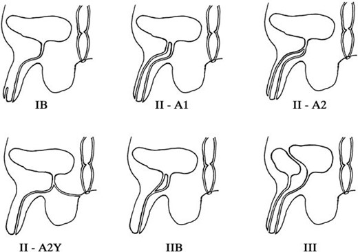 The Effmann classification system divides duplications by their therapeutic interventions and is therefore more useful for surgical planning. A blind incomplete accessory urethra is Type 1. Type 2 represents a complete functional duplication of the urethra with subtypes differentiating the origin of the duplication at either the bladder or along the orthotopic urethra. Further subtype differentiation of Type 2 duplications are determined by their site of termination; either terminating at the penile dorsum, perineum or reconnecting with the orthotopic urethra more distally in its course. Type 3 duplications are complete duplications of the bladder and functional urethra.20