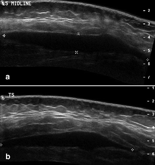 (a) Longitudinal and (b) transverse initial ultrasound of retrosacral Morel-Lavallée lesion at presentation, prior to aspiration. There is a hypoechoic focal fluid collection lying between the deep margin of the subcutaneous fat and the underlying fascia.