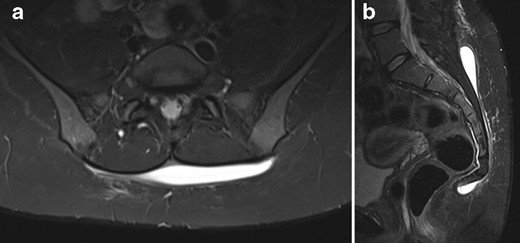 (a) Axial and (b) sagittal initial short tau inversion recovery (MRI) of retrosacral Morel-Lavallée lesion following three percutaneous aspirations. There is a high signal collection seen at the deep margin of the subcutaneous fat, but superficial to the fascia overlying the paraspinal musculature. On the sagittal sequence distal extension of the lesion to the level of the coccyx is identified.