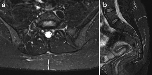 (a) Axial and (b) sagittal short tau inversion recovery (MRI) of sacrum post-sclerotherapy showing no recurrent fluid collection. Trace increased signal at site of previous lesion is likely post-procedural in nature. Sagittal sequence confirms resolution of distal extension of lesion also.
