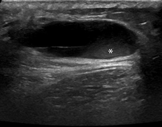 Transverse sonographic image of the upper back shows a predominantly anechoic subcutaneous lesion with posterior acoustic enhancement containing a small soft tissue nodular component (*).