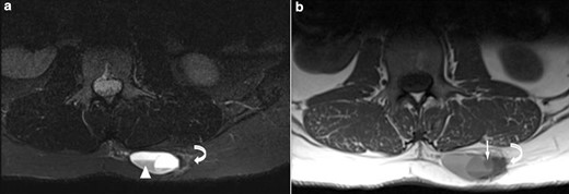 (a) Axial T2 STIR & (b) Axial T1 MR images show a well-defined subcutaneous lesion containing fluid–fluid levels (white arrowhead) and an internal solid nodule (white arrow) with ill-defined low signal change in the adjacent subcutaneous fat on the lateral margin (curved arrow). STIR, short tau inversion recovery.