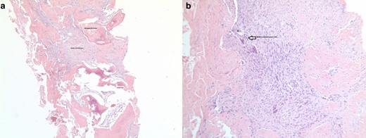 Histopathology slide from the soft tissue biopsy shows 3a metaplasia around the soft tissue GCT and 3b multinucleated giant cells within the soft tissue GCT. GCT, giant cell tumour.