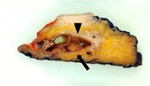 Section through the surgical specimen shows a cystic mass (arrowhead) with an internal soft tissue nodule (arrow) and lateral fat change (*).
