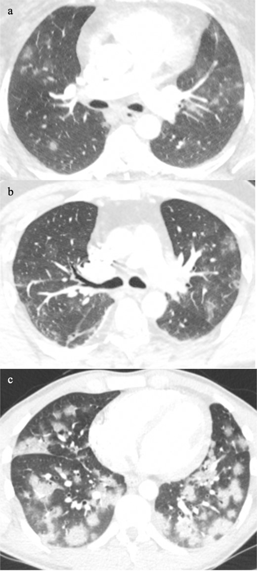 Classic multifocal pattern of COVID-19 pneumonia from minor small foci (a), ill-defined ground glass patches (b), to dense ground glass foci in a random distribution (c).