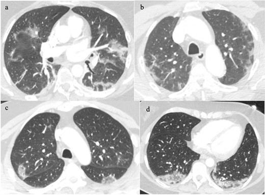 Classic COVID-19 pneumonia patterns that mimic organising pneumonia such as peripheral perilobular ground glass opacification (2a&b), and reverse halo signground glass opacification (2c&d).