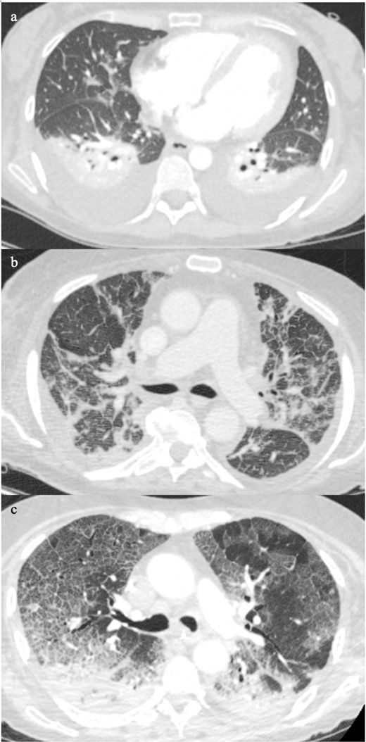 Patient A (Figure 3a) and Patient B (Figure 3b) showed different severity of interlobular septal thickening and the associated ground glass opacification is located mainly in the dependent positions. Patient C (Figure 3c) the ground glass opacification is uniformly distributed within the areas of smooth interlobular thickening resulting in the characteristic crazy-paving sign, a classic pattern on COVID-19 pneumonia.