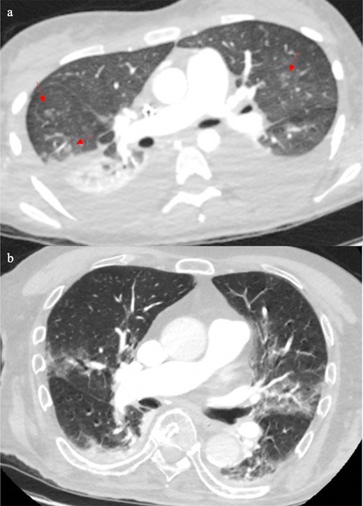 Patient D’s CT (4a) showed bilateral pleural effusions with patchy ground glass and ground glass nodularity (arrows), which is more common in bacterial infections, or if someone is immunocompromised, fungal infection is also a possibility. Patient E’s CT (4b) showed bilateral small pleural effusions with bronchocentric ground glass opacification, which in the right clinical context it could be supportive of COVID-19 pneumonia.