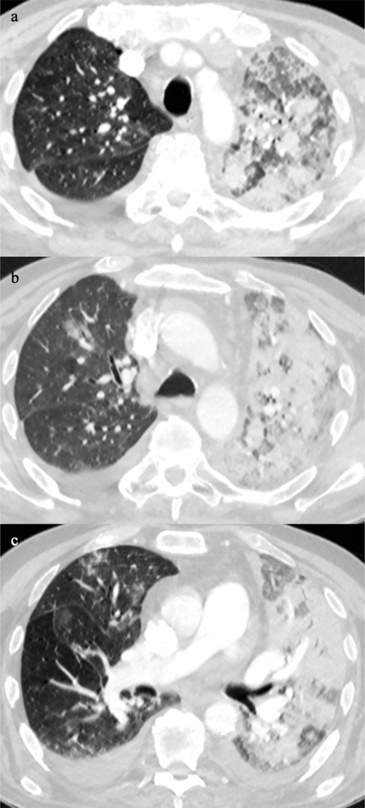 Chest CT showed predominately bronchocentric ground glass opacification in the right upper lobe and middle lobe with bilateral pleural effusions and dense consolidation on the left (5a-c).