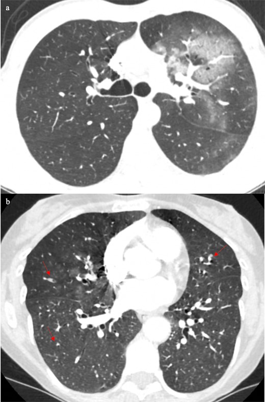 The CT showed predominantly left upper lobe central ground glass opacification (6a), which would favour lobar pneumonia, but COVID-19 infection is not completely excluded since it can also produce upper zone central ground glass opacification. Detailed inspection of the rest of the CT showed mucus plugging in the area of ground glass (Fig b, arrow), which would be consistent with bacterial infection.