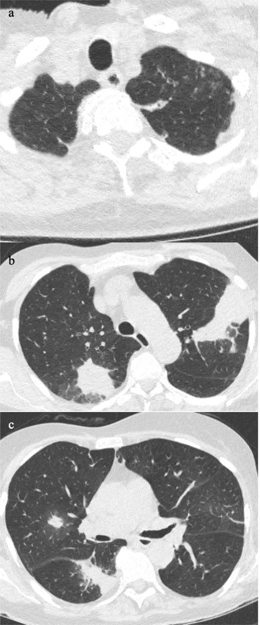Patient has acute myeloid leukaemia and presented with neutropenic sepsis and cough. The chest CT showed mucus plugging and nodular ground glass in the left lung apex (7a), which is most likely due to bacterial infection. The mass-like consolidation in the rest of the lungs (7b-c) and a solid nodule with surrounding ground glass in the right upper lobe (7c) is more favourable of fungal infection.