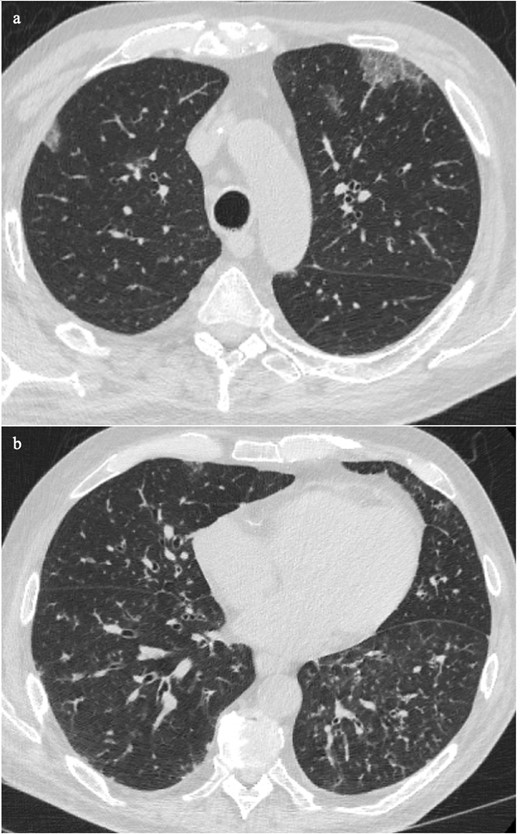 This patient is immunosuppressed with cough and fever. The CT showed peripheral crazy paving in the upper lobes, which is supportive of COVID-19 infection (8a). The bronchiectasis and mucus plugging in the lower lobes are typical of bacterial infection (8b)