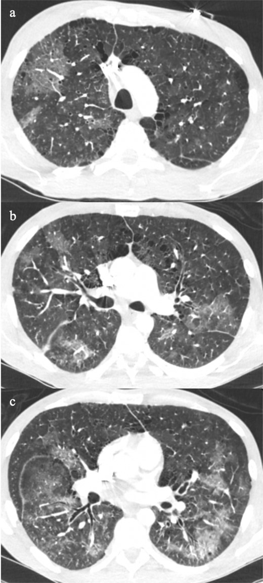 Patient was newly diagnosed with HIV and presented with fever and cough. The chest CT showed bilateral patchy ground glass opacification and slightly worse in the lower lobes (9a–c). The pattern is non-specific and could be due to various opportunistic organisms. Later, he was confirmed to have Epstein-Barr viral infection, which induced HLH. HLH, haemophagocytic lymphohistiocytosis.
