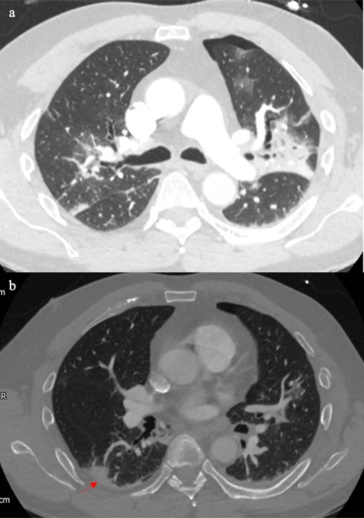 Patient with fall onto left side and trauma CT showed left-sided pneumothorax with associated left-sided rib fractures (10a–b). The centrally affected areas particularly those in the right lung were most likely from COVID-19 infection.The right posterior peripheral consolidation (arrow) could be from contre-coup injury, but infective consolidation was also possible given the absence of subpleural sparing for acute contusion.