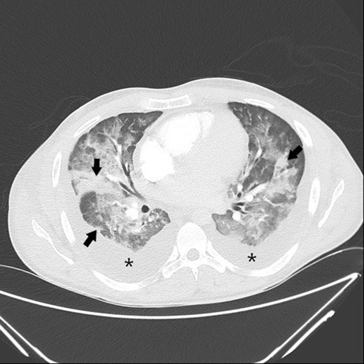 Axial contrast-enhanced CT scan of the chest shows bilateral pleural effusion (*) and multifocal patchy consolidations (black arrows).