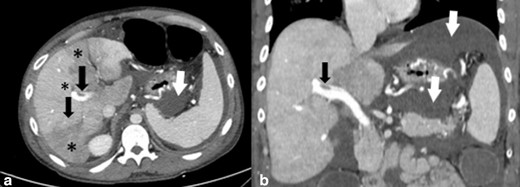 Axial (a) and coronal (c) contrast-enhanced CT images of the abdomen demonstrate a clot within the portal vein (black arrows). There are altered patchy areas of hepatic parenchymal enhancement (*) that are suggestive of occlusion of small branches of the portal vein. Intraperitoneal fluid is also seen on CT images (white arrows).