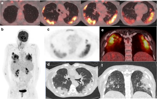 (a) Axial-fused thoracic 18FDG-PET/CT, (b) maximum-intensity projection, (c) 18FDG-PET thorax, (d) axial low-dose CT thorax (e) coronal fused 18FDG-PET/CT, (f) coronal thoracic CT. The images demonstrate hypermetabolic patchy peripheral consolidation and GGO in four lobes and subcarinal lymph node. 18FDG-PET, 18-fludeoxyglucose-positron emmision tomography; GGO, ground glass opacity.