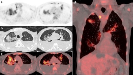 (a) 18FDG-PET thorax, (b) axial low-dose CT thorax, (c) axial fused thoracic 18FDG-PET/CT, (d) coronal fused thoracic 18FDG-PET/CT. The images demonstrate hypermetabolic patchy perihilar consolidation and GGO in three lobes and avid mediastinal lymph nodes. 18FDG-PET, 18-fludeoxyglucose-positron emmision tomography; GGO, ground glass opacity.