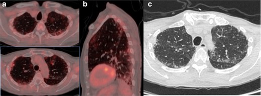 (a) Axial fused thoracic 18FDG-PET/CT, (b) sagittal fused thoracic 18FDG-PET/CT, (c) axial low-dose CT thorax. The images demonstratemultifocal biapical mildly avid GGO. 18FDG-PET, 18-fludeoxyglucose-positron emmision tomography; GGO, ground glass opacity.