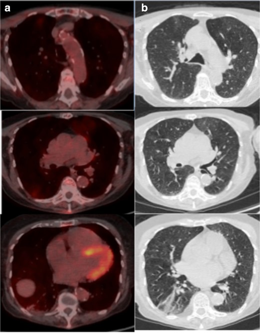 (a) Axial fused thoracic 18FDG-PET/CT, (b) axial low-dose CT thorax. The images demonstrate hypermetabolic GGO in three lobes with plugging and atelectasis in the lower lobes. 18FDG-PET, 18-fludeoxyglucose-positron emmision tomography; GGO, ground glass opacity.
