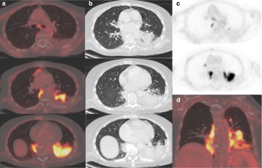 (a) Axial fused thoracic 18FDG-PET/CT, (b) axial low-dose CT thorax, (c) 18FDG-PET thorax, (d) coronal fused 18FDG-PET/CT. The images demonstrate hypermetabolic patchy consolidation in the lower lobes and left upper lobe. Mildly avid subcarinal lymph node. 18FDG-PET, 18-fludeoxyglucose-positron emmision tomography.