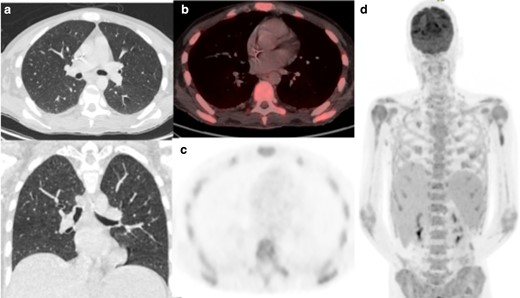 (a) Axial low-dose CT thorax, (b) axial fused thoracic 18FDG-PET/CT, (c) 18FDG-PET thorax, (d) Maximum-intensity projection. The images demonstrate diffuse marrow uptake. No lung parenchymal change or increased tracer uptake. 18FDG-PET, 18-fludeoxyglucose-positron emmision tomography.