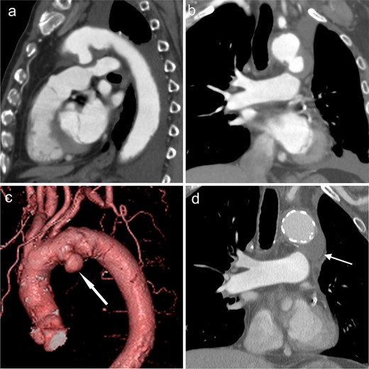Ductus arteriosus aneurysm (white arrows) shows extending posteroinferiorly from the left side-of the aortic arch on (a) sagittal multiplanar reconstruction, (b) coronal multiplanar reconstruction, and (c) 3DCT angiography images in Case 1. (d) After complete arch replacement and open stent grafting, dilated aneurysms diminished, resulting in a good outcome during follow-up.