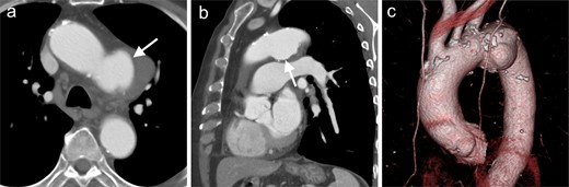 Ductus arteriosus aneurysm (white arrows) shown on is reveal in (a) axial image, and (b, c) 3DCT angiography imaging in Case 3. 3D, three-dimensional.