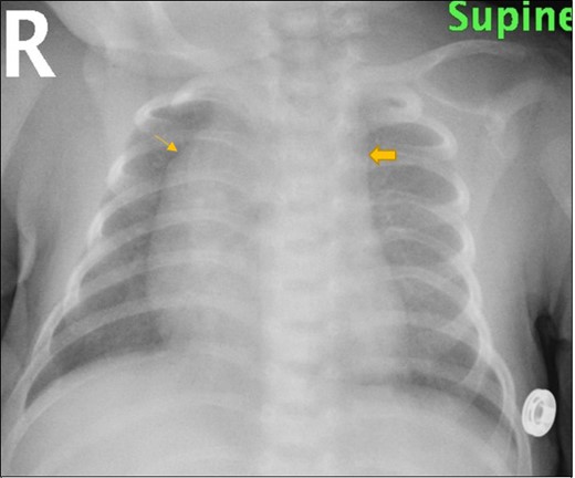 Chest X-ray frontal view shows straightening of the left cardiac border with loss of left aortic contour (block arrow) and prominent right para tracheal soft tissue (single arrow)