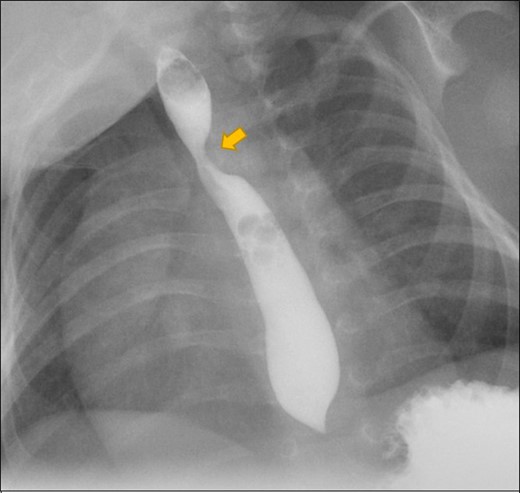 Upper GI contrast study (oblique view) shows postero-lateral indention on the contrast filled oesophagus at the level of 5th/6th thoracic vertebra. (block arrow)