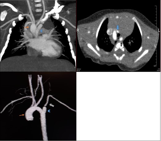 CT angiography (a) coronal, (b) axial and (c) 3D reconstructed views show right-sided aortic arch (orange arrow) with aberrant left subclavian artery ALSA (white arrow) which arises from a dilatation at its origin (KD; arrowhead). Left CCA arising from right-sided aortic arch coursing anterior to the trachea (blue arrow), ALSA courses posterior to oesophagus (black arrow) on the left side-making a vascular ring.