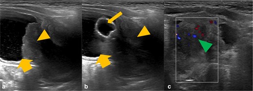 Grayscale ultrasound images of the bladder and prostate gland (A and B) with further colour doppler ultrasound (C). There is a heterogeneous mass in the expected location of the prostate gland (orange arrowhead), which is invaginating into the urinary bladder base (thick orange arrow). There is evidence of increased internal vascularity (green arrowhead). The urinary catheter courses through the mass and the balloon is within the urinary bladder (thin orange arrow).