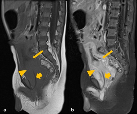Sagittal T1 pre- (A) and post-contrast (B) MRI images of the abdomen and pelvis. There is an avidly enhancing prostatic mass (orange arrowhead), invaginating into the urinary bladder base (thin orange arrow). The urinary catheter is coursing through the mass (thick orange arrow).