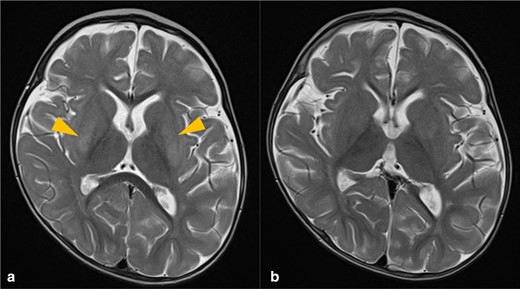 T 2-weighted axial MRI sequences demonstrating high signal within the putamina bilaterally (orange arrowheads) (A), which has subsequently resolved upon follow-up imaging two months later (B).