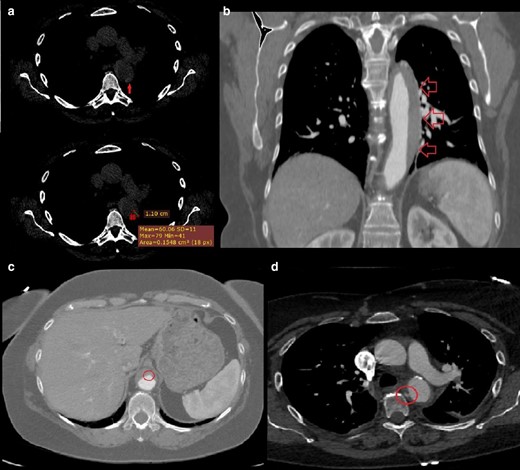 (day 1): (a) Non-enhanced CT axial scan at the level of the origin of the left pulmonary artery: a 11-mm crescent-shaped hyper attenuating (60 HU) thickening within the wall of the descending aorta on its lateral aspect is seen. (day 4, b) Contrast-enhanced CT coronal scan at the level of thoracic aorta: we appreciate the approximate extension of the above-described aortic thickening, that is, from the left subclavian artery to the celiac trunk. (c) Contrast-enhanced axial CT scan at the level of the upper abdomen: a small bulge of contrast is seen on the anterior aspect of the abdominal aorta, likely representing the “exit tear” of an aortic dissection whose thrombosis has led to the development of the AIH. (day 4, d) Contrast-enhanced CT axial scan at the level of the origin of the left pulmonary artery: a focal blush within a thrombotic lesion (7 × 3 mm, with a millimetric “peduncle”) on the medial aspect of the descending aorta is seen, likely representing the “entry tear” of the above-mentioned aortic dissection.