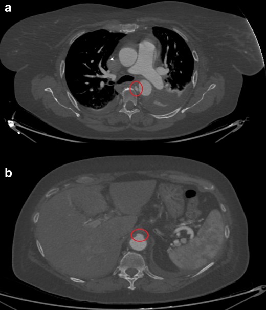 (day 8): Contrast-enhanced CT axial images at the level of the bifurcation the pulmonary trunk (a) and the upper abdomen (b): enlargement of both the entry (a) and the exit tears (b) is seen, indicating impending aortic dissection or rupture.