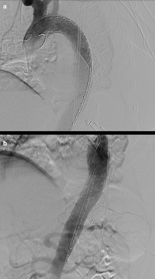 (day 8): Digital subtraction angiography images at the level of the cranial (a) and caudal (b) segments of the thoracic aorta (a): optimal positioning of a Valiant Navion 34 × 174 mm stent graft (Medtronic Vascular, Santa Rosa, Calif) is documented, with the “free-flow” portion at the origin of the left subclavian artery (with caudal aortic diameter measuring 29 mm).