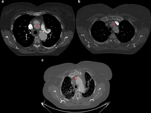 (day 42, a, b) Contrast-enhanced CT axial scans at the level of the origin of the left pulmonary artery: an intimal-medial flap cranially to the stent graft extending to the origin of the right coronary artery is seen and is consistent with “retrograde aortic dissection type A”. (day 52, (c) Contrast-enhanced CT axial scan at the level of the aortic arch following cardiac surgery: a small bulge of contrast on the antero medial aspect of the ascending aorta is seen, likely representing the “entry tear” of above-mentioned retrograde dissection type A.