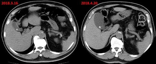 Axial abdominal CT scan (before colon surgery) revealed a slightly uniform thickening of gallbladder wall and gallbladder stones. Post-operative 1 month abdominal CT scan only showed a distended gallbladder and gallbladder stones without thickening of the gallbladder wall. And, there was no abnormalities in the left peritoneum at that time.