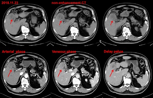 Post-operative 9 month contrast-enhanced CT images detected uneven thickening of gallbladder wall with a progressive enhancement pattern(red arrow), accompanied by gallbladder stones and a rim-like pattern enhancement of left peritoneum(white arrow).
