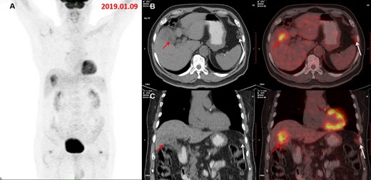 The MIP of the concurrent 18F-FDG PET/CT (A) demonstrated two foci with increased metabolic activity in gallbladder bed and left peritoneum. Axial (B) and coronal (C) PET/CT images showed increased FDG accumulation in the irregular thickened wall of the gallbladder, invading liver parenchyma and hepatic flexure of transverse colon, suggesting a malignant gallbladder lesion(red arrow), with SUVmax 5.0 and several nodules and patches on the left peritoneal area(anterior to the spleen) with a slightly increased FDG uptake(SUVmax:3.3), which was not showed on the preoperative PET/CT images, mimicking peritoneal metastasis (white arrow) form colon cancer. FDG, fludeoxuglucose; MIP, maximum intensity projection; PET, positron emmision tomography; SUVmax, maximum standardized uptake value.