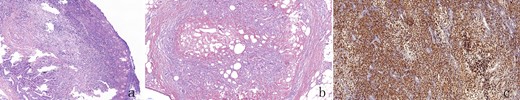 HE staining showed a large number of lymphocytes, plasma cells and neutrophils infiltration, and fibrous tissue hyperplasia, along with the accumulation of foam cells (c) in both gallbladder (a) and left peritoneum (b). No malignant cells were detected (a,b,c,×100) .