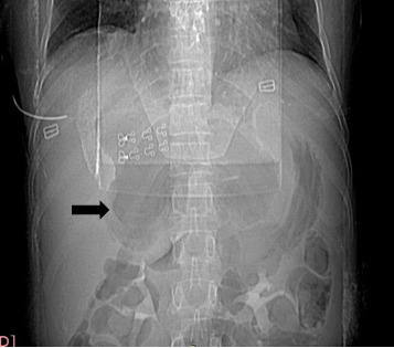 X-ray of the abdomen without preparation: Large extra luminal gas collection (black arrow).